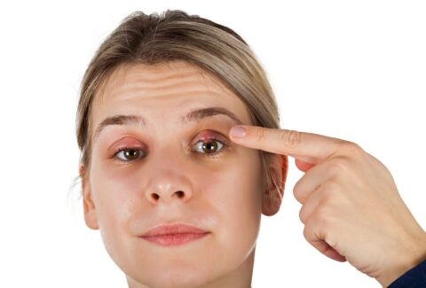 Understand everything about Chalazion by ADC