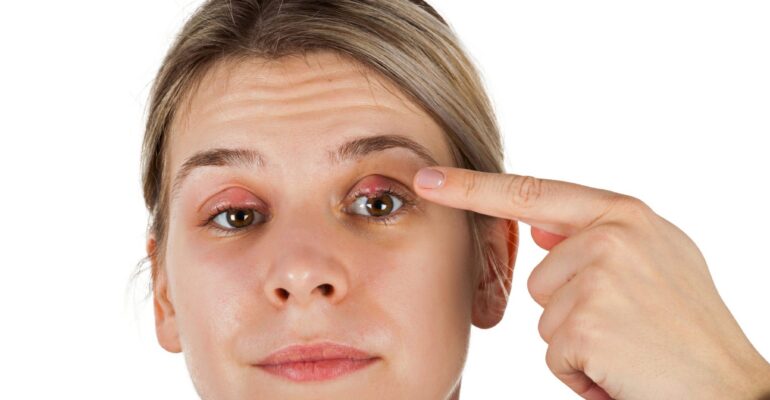 Understand everything about Chalazion by ADC