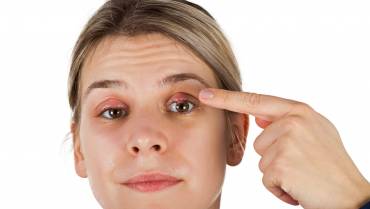 Understand Everything About Chalazion
