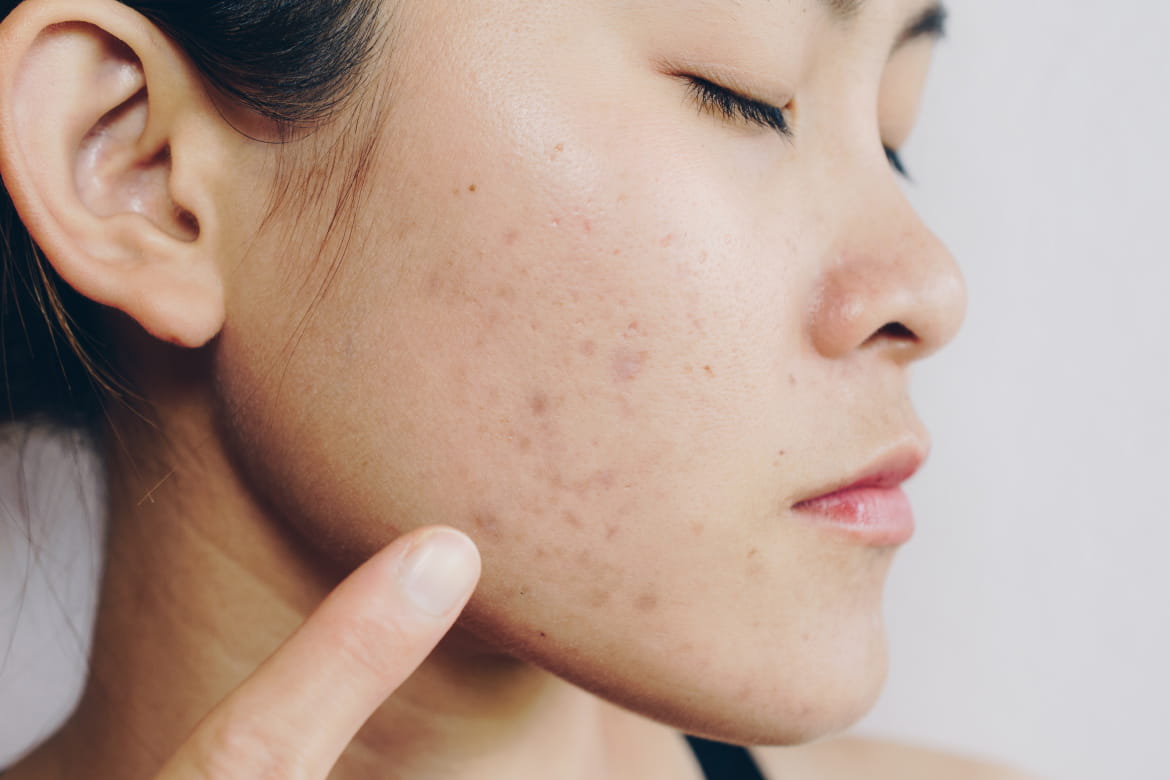 Identify different types of acne