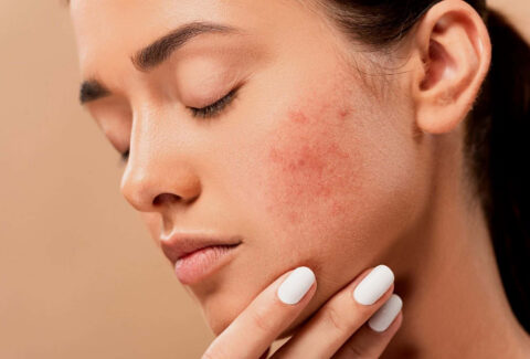 Types of acne