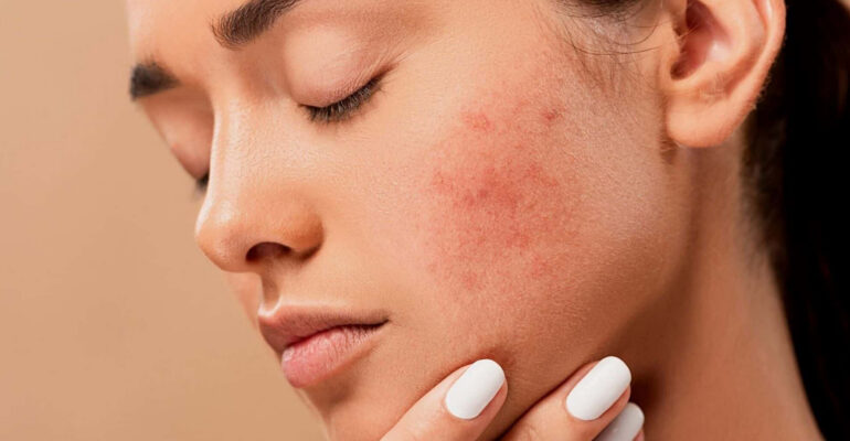 Types of acne