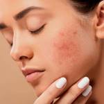 Identify Different Types of Acne