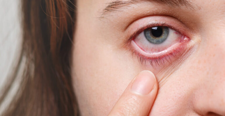 Watery eyes and it's effect