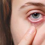 Effective Eye Drops for Watery Eyes