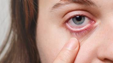 Effective Eye Drops for Watery Eyes