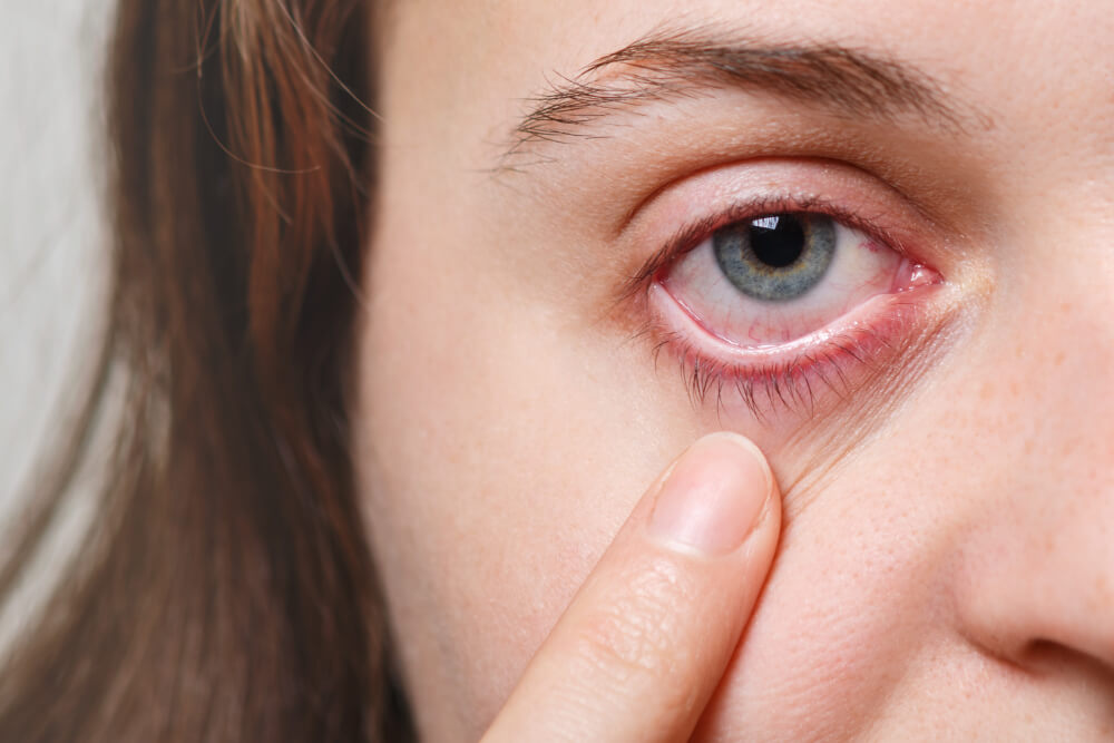 Effective Eye Drops for Watery Eyes
