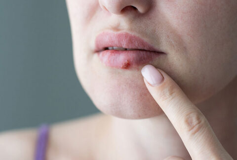 Herpes and HIV treatment options