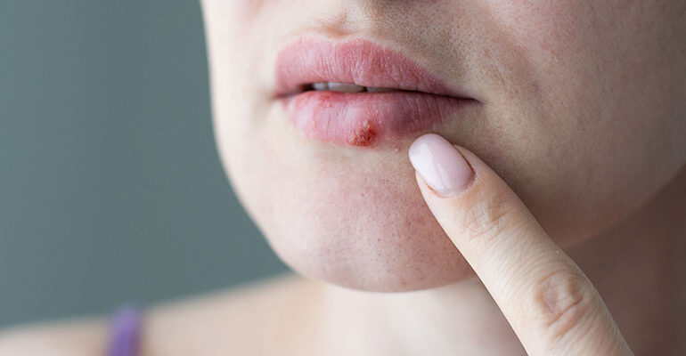 Herpes and HIV treatment options