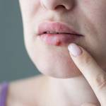 How are herpes transmitted: A Detailed Guide