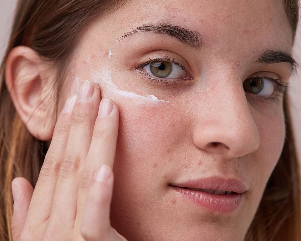 How to treat acne-prone skin in 7 days?