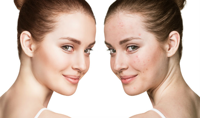 Acne Treatment - How to Get Acne Prone Skin in 7 Days