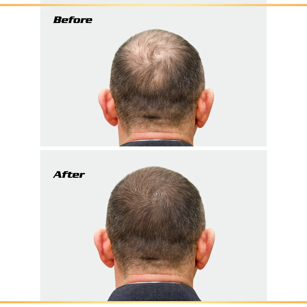 hair loss treatment.