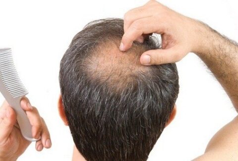hair loss treatment.