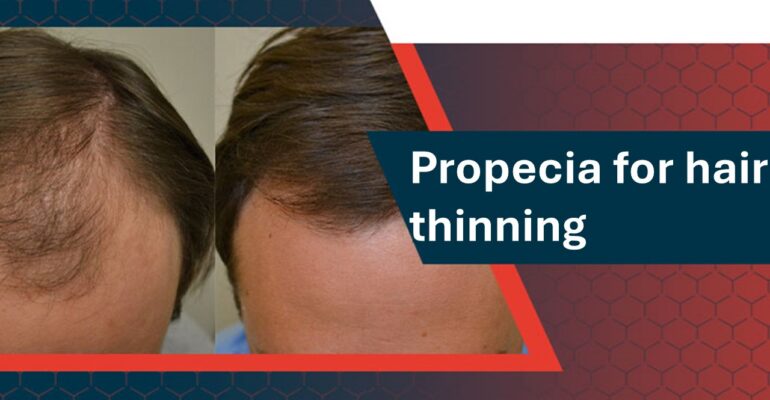 propecia for hair loss