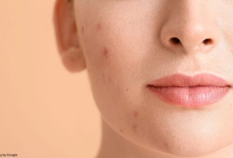 hydroquinone cream 4 melalite forte