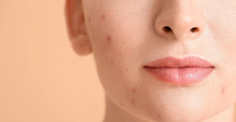 hydroquinone cream 4 melalite forte