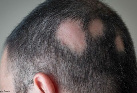 finasteride 5mg - All Day Chemist