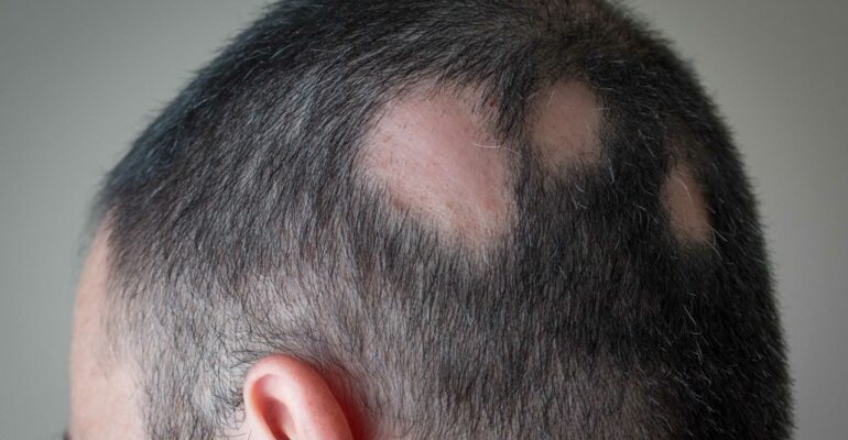 finasteride 5mg - All Day Chemist