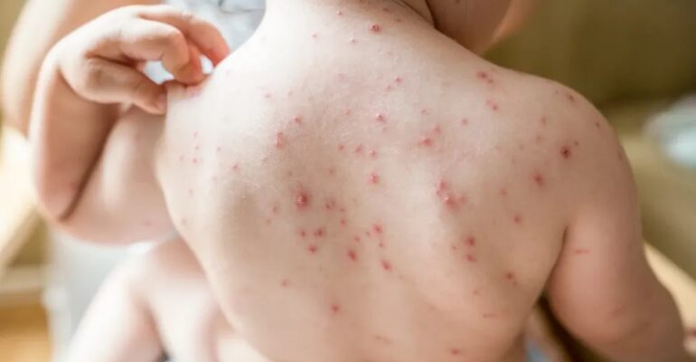 hydroxychloroquine for lupus - All Day Chemist