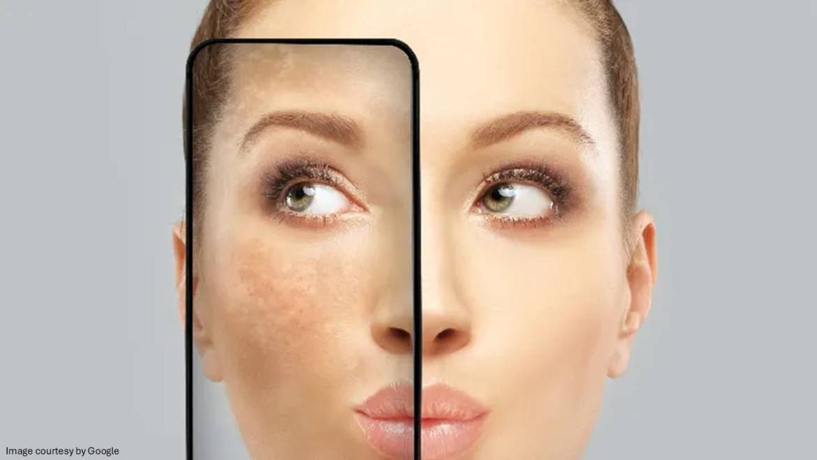 Understanding what triggers melasma and how to avoid it.