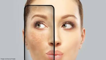 Understanding what triggers melasma and how to avoid it.