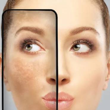 Understanding what triggers melasma and how to avoid it.