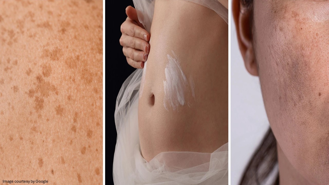 Melasma Treatment - ADC​ 