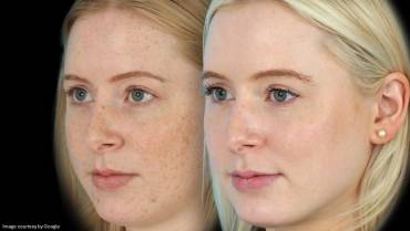 Common mistakes people make when using Melalite Forte Cream