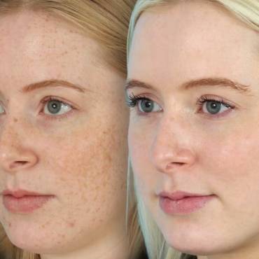 Common mistakes people make when using Melalite Forte Cream