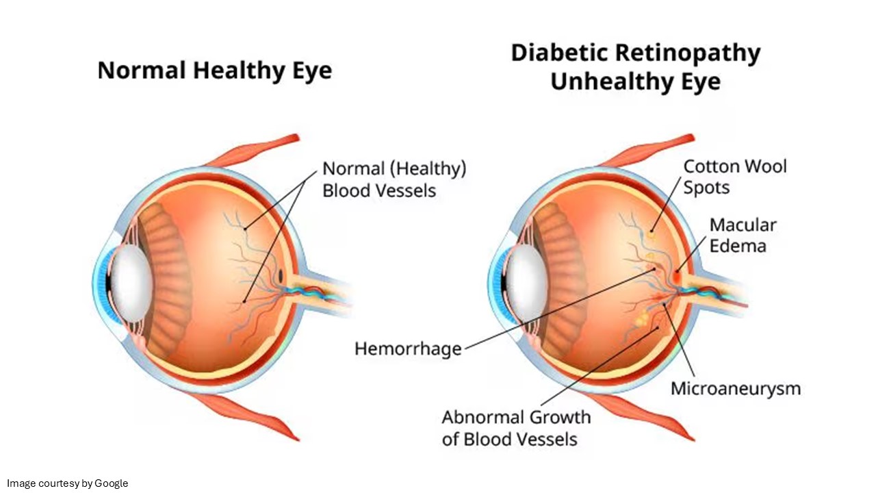 Diabetes and eye care​
