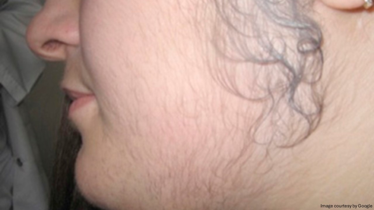 A lady side face with hair growth