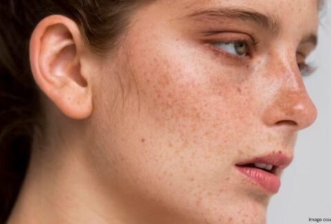 A girl face with melasma