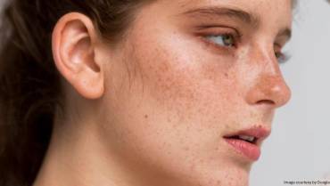 What Is Melasma? Everything You Need to Know About