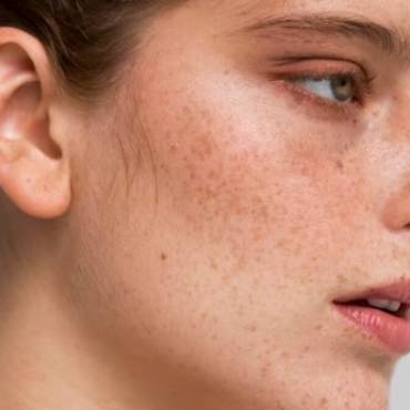 What Is Melasma? Everything You Need to Know About