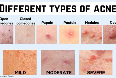 Different type of ache
