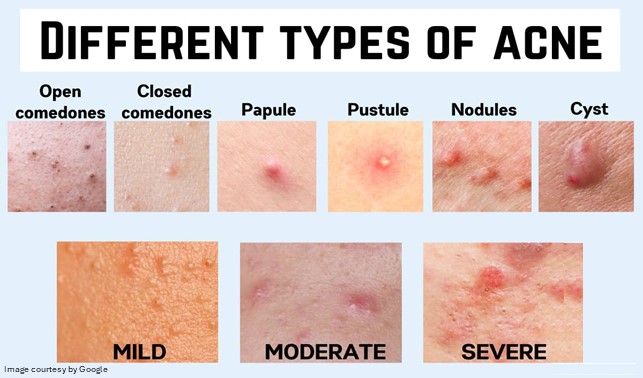 Different type of ache