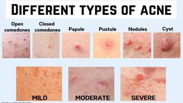 Understanding the Different Types of Acne