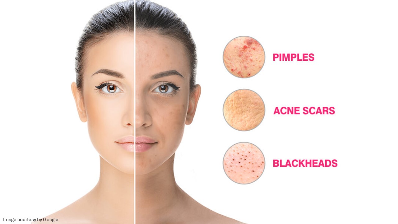 Face showing pimples, acne scars, blackheads