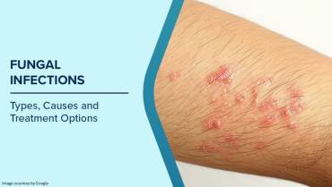 Myths and facts about fungal infections