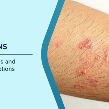 Myths and facts about fungal infections