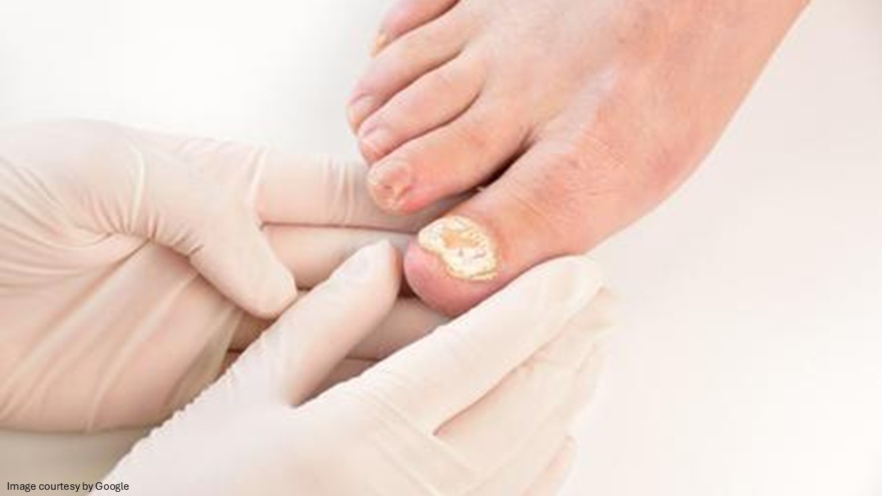 doctor checking a fungal infection on toe