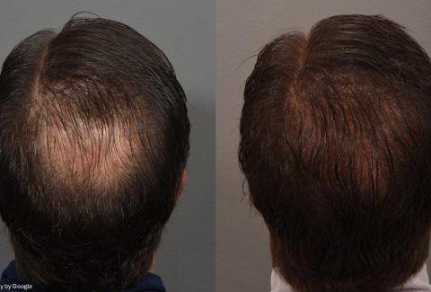 Before and after of hair loss pattern