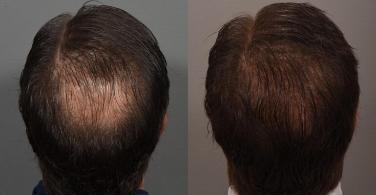 Before and after of hair loss pattern