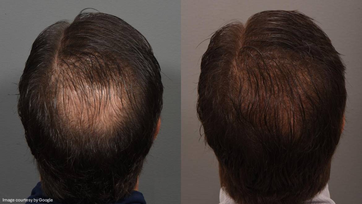 What are hair loss patterns, and why do they matter?