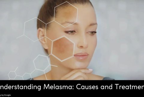 Undertanding melasma causes and treatment
