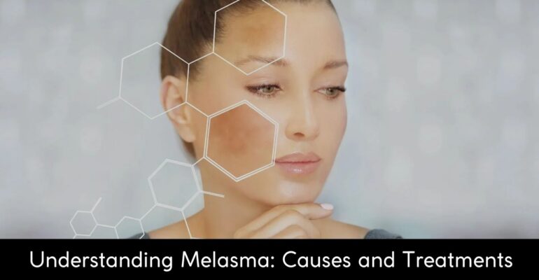 Undertanding melasma causes and treatment