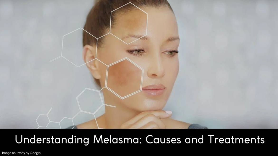 Understand the Causes and Treatments of Melasma