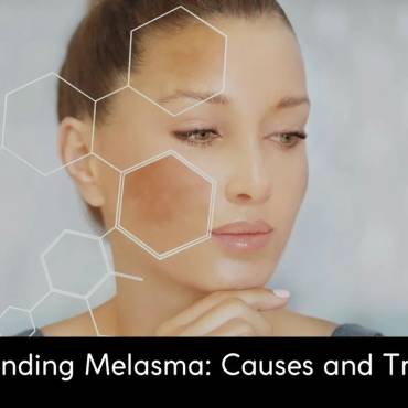 Understand the Causes and Treatments of Melasma