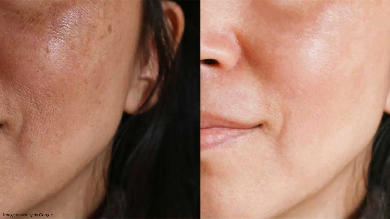 melasma causes